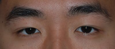Asian / Ethnic Surgery Before & After Gallery - Patient 119284 - Image 1