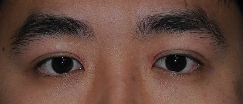 Eye Lift Before & After Gallery - Patient 239316 - Image 2