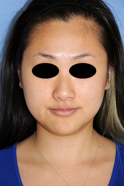 Asian / Ethnic Surgery Before & After Gallery - Patient 986931 - Image 1