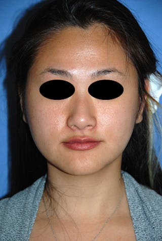 Asian / Ethnic Surgery Before & After Gallery - Patient 986931 - Image 2