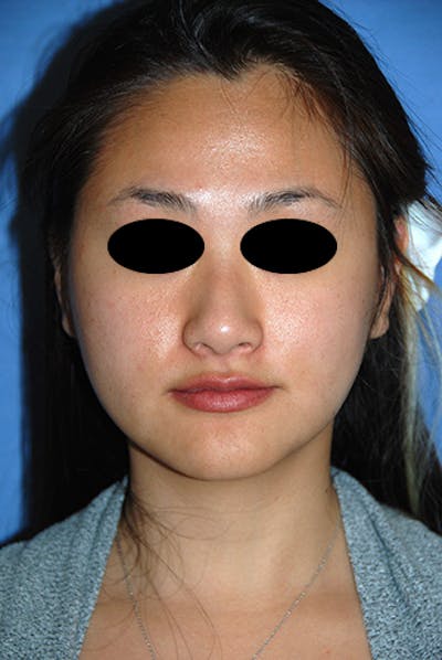Asian / Ethnic Surgery Before & After Gallery - Patient 986931 - Image 2