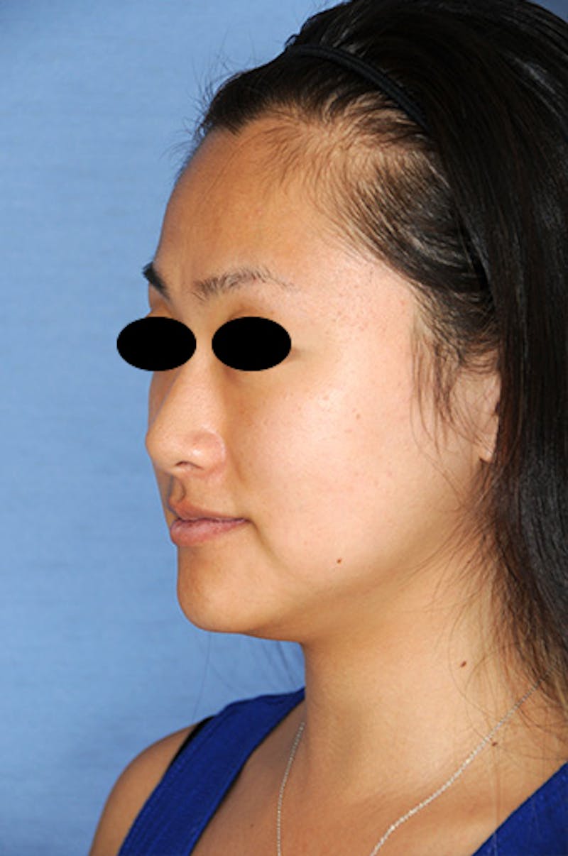 Asian / Ethnic Surgery Before & After Gallery - Patient 986931 - Image 3