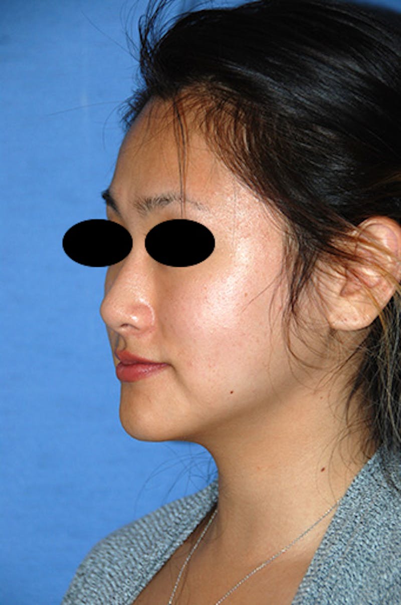 Asian / Ethnic Surgery Before & After Gallery - Patient 986931 - Image 4