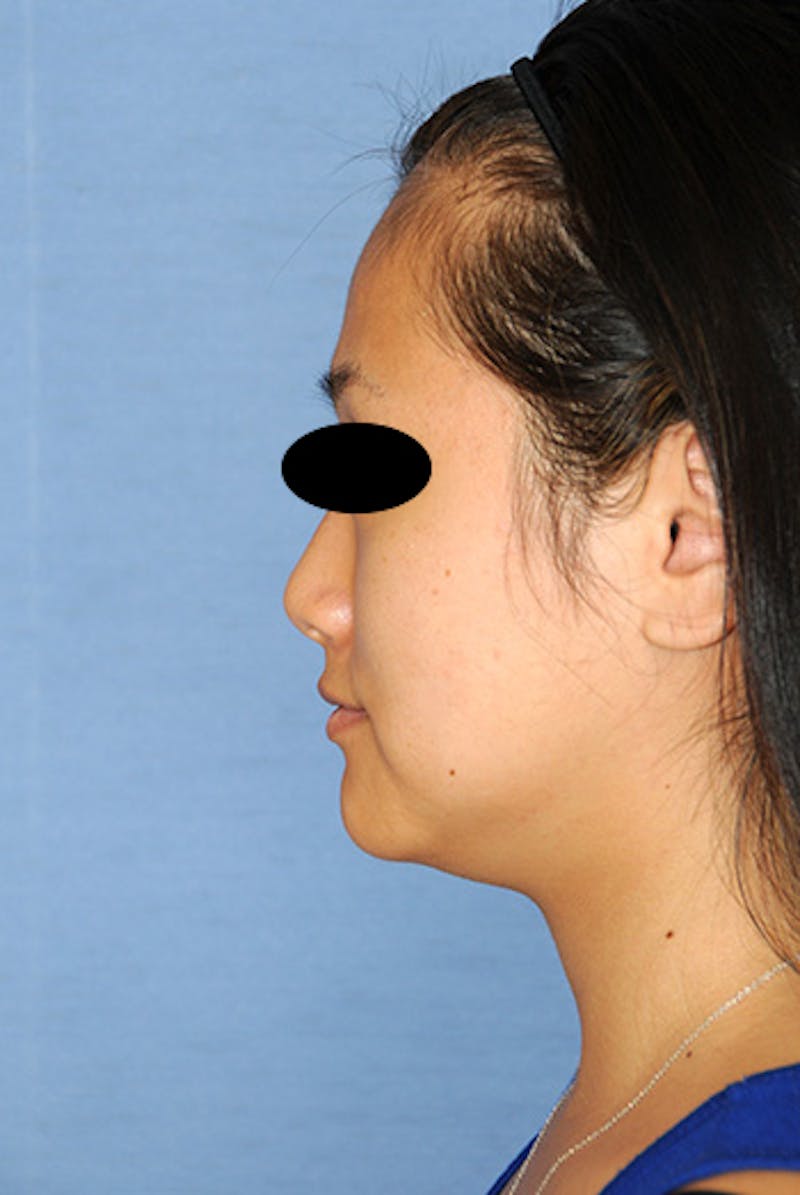 Asian / Ethnic Surgery Before & After Gallery - Patient 986931 - Image 5