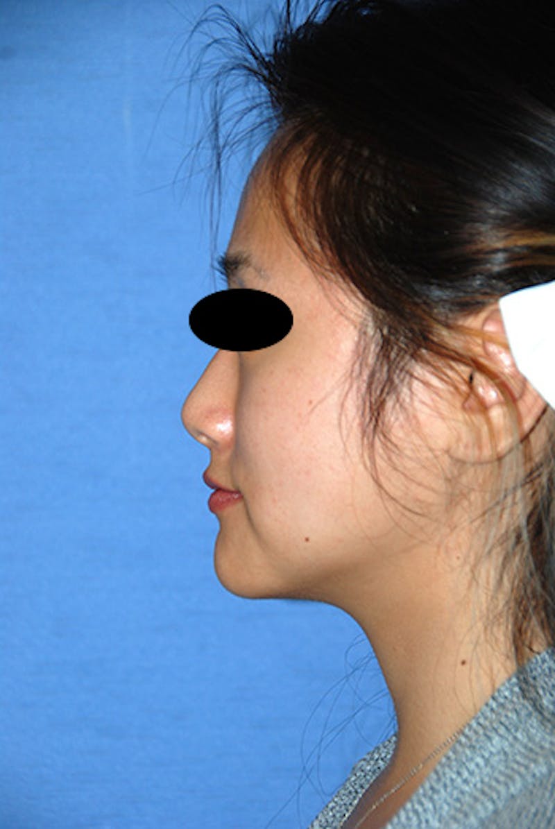 Asian / Ethnic Surgery Before & After Gallery - Patient 986931 - Image 6