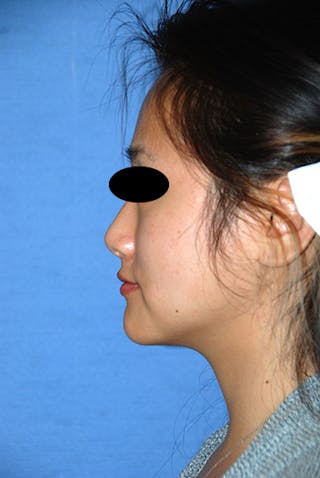 Asian / Ethnic Surgery Before & After Gallery - Patient 986931 - Image 6