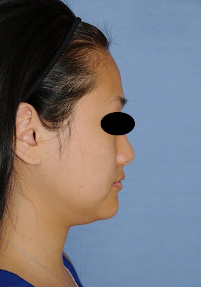 Asian / Ethnic Surgery Before & After Gallery - Patient 986931 - Image 7