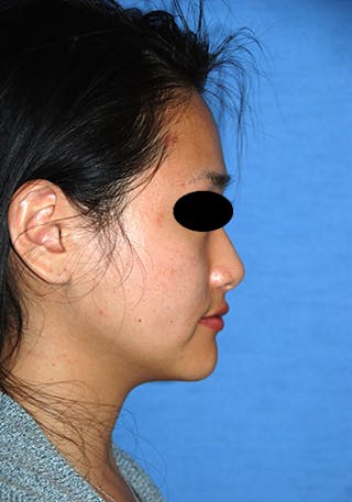 Asian / Ethnic Surgery Before & After Gallery - Patient 986931 - Image 8