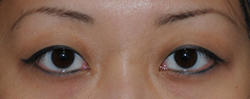 Asian / Ethnic Surgery Before & After Gallery - Patient 395821 - Image 1