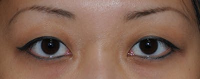 Asian / Ethnic Surgery Before & After Gallery - Patient 395821 - Image 1