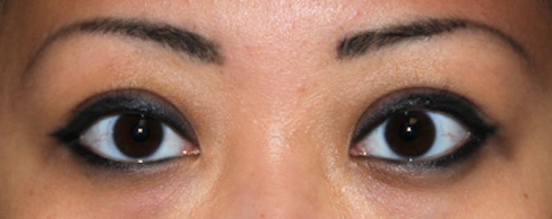 Asian / Ethnic Surgery Before & After Gallery - Patient 395821 - Image 2
