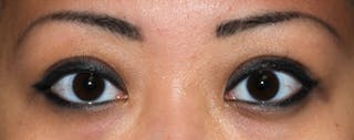 Asian / Ethnic Surgery Before & After Gallery - Patient 395821 - Image 2
