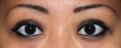 Asian / Ethnic Surgery Before & After Gallery - Patient 395821 - Image 2