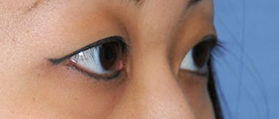 Eye Lift Before & After Gallery - Patient 118431 - Image 1