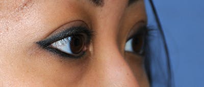 Eye Lift Before & After Gallery - Patient 118431 - Image 2