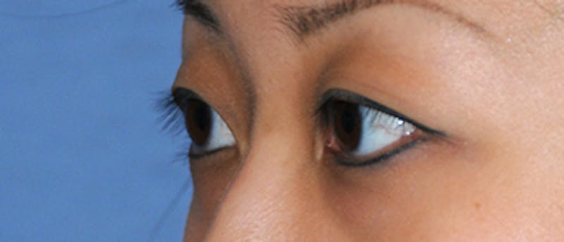 Asian / Ethnic Surgery Before & After Gallery - Patient 395821 - Image 5