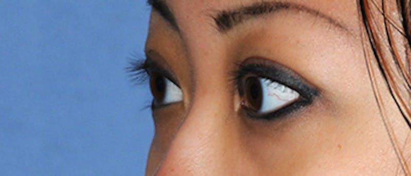 Asian / Ethnic Surgery Before & After Gallery - Patient 395821 - Image 6