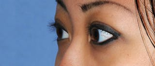 Asian / Ethnic Surgery Before & After Gallery - Patient 395821 - Image 6