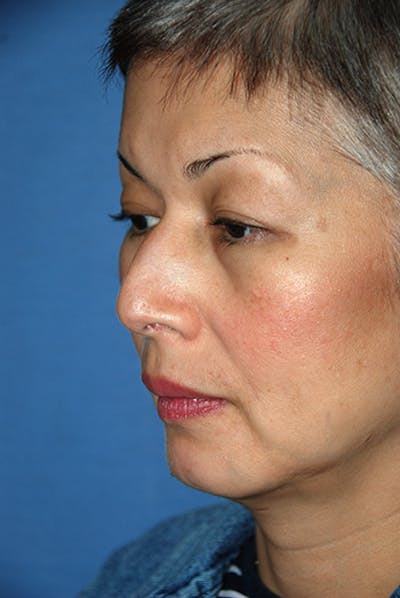 Asian / Ethnic Surgery Before & After Gallery - Patient 259133 - Image 1