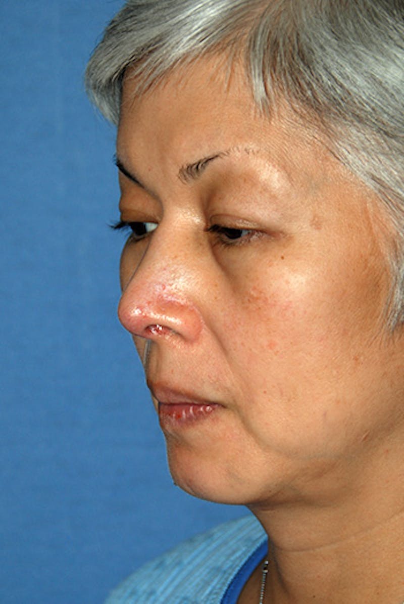 Asian / Ethnic Surgery Before & After Gallery - Patient 259133 - Image 2