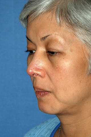 Asian Rhinoplasty Before & After Gallery - Patient 315115 - Image 2