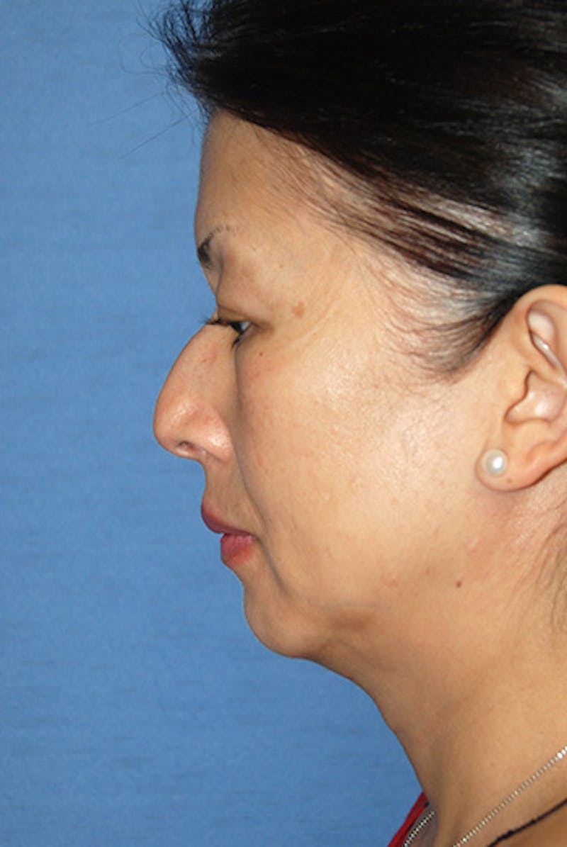 Asian / Ethnic Surgery Before & After Gallery - Patient 259133 - Image 3