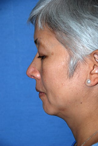 Asian Rhinoplasty Before & After Gallery - Patient 315115 - Image 4