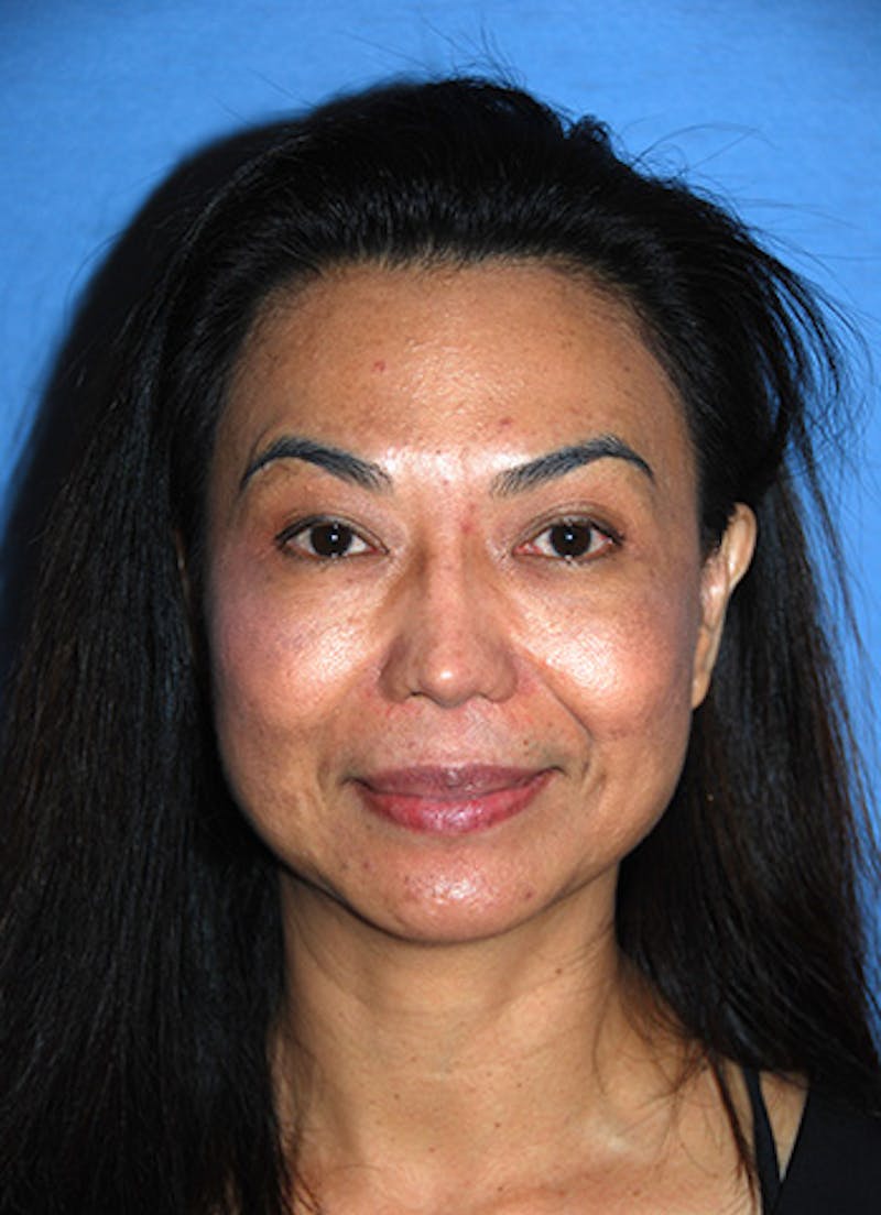 Asian Rhinoplasty Before & After Gallery - Patient 245724 - Image 1