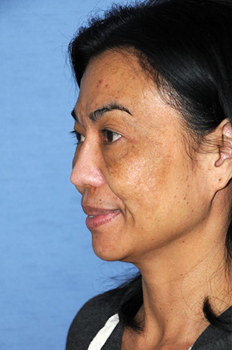 Asian Rhinoplasty Before & After Gallery - Patient 245724 - Image 3