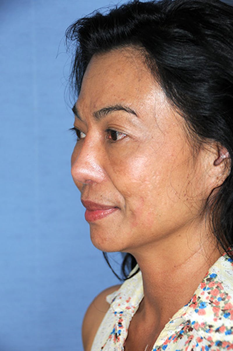 Asian Rhinoplasty Before & After Gallery - Patient 245724 - Image 4