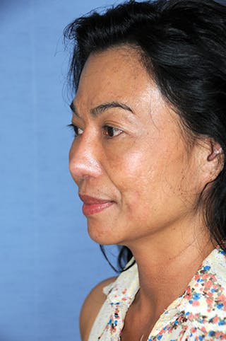 Rhinoplasty Before & After Gallery - Patient 444533 - Image 4
