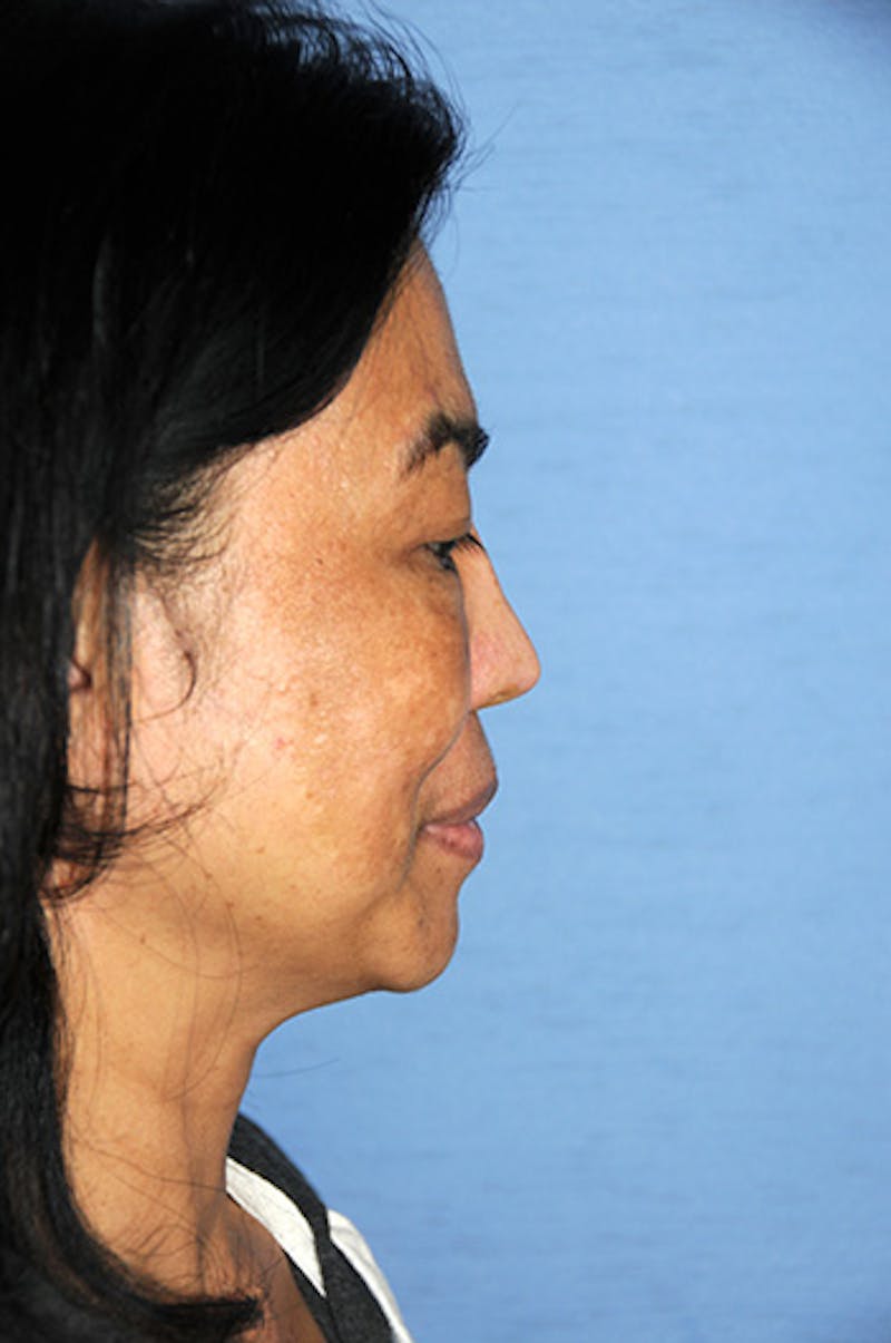 Asian Rhinoplasty Before & After Gallery - Patient 245724 - Image 5