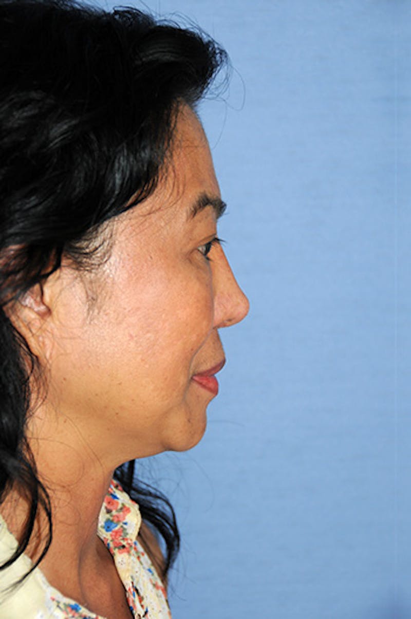 Asian Rhinoplasty Before & After Gallery - Patient 245724 - Image 6