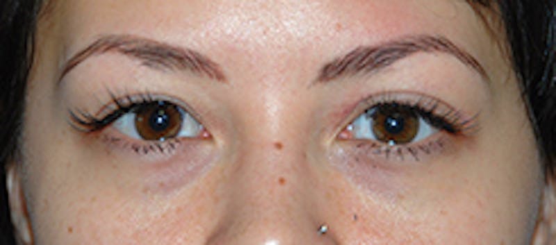 Eye Lift Before & After Gallery - Patient 158692 - Image 1