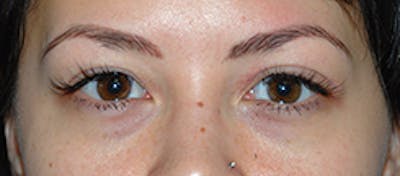 Asian / Ethnic Surgery Before & After Gallery - Patient 103543 - Image 1
