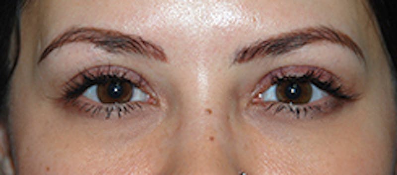 Eye Lift Before & After Gallery - Patient 158692 - Image 2