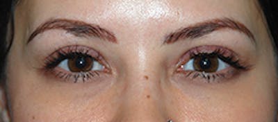 Asian / Ethnic Surgery Before & After Gallery - Patient 103543 - Image 2