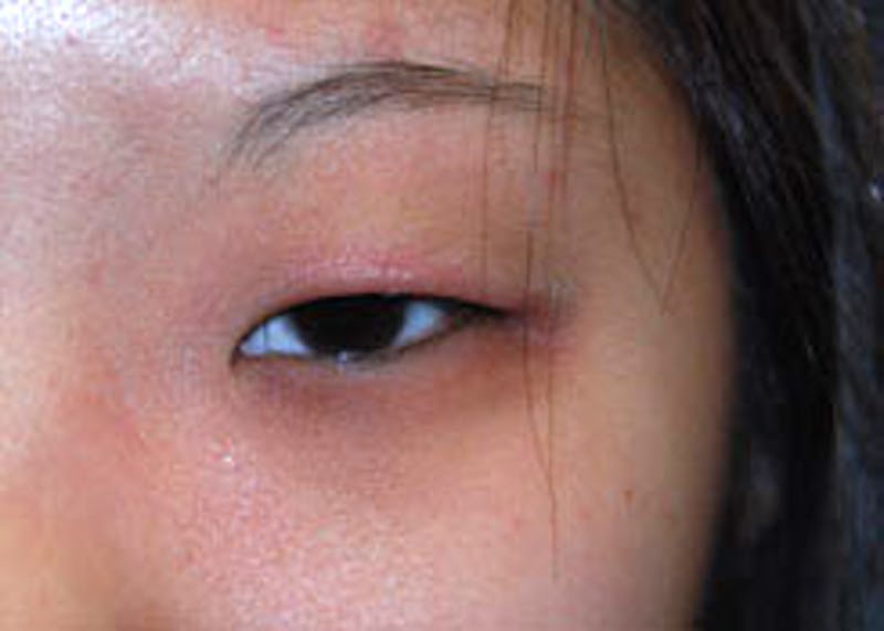 Eye Lift Before & After Gallery - Patient 696920 - Image 1