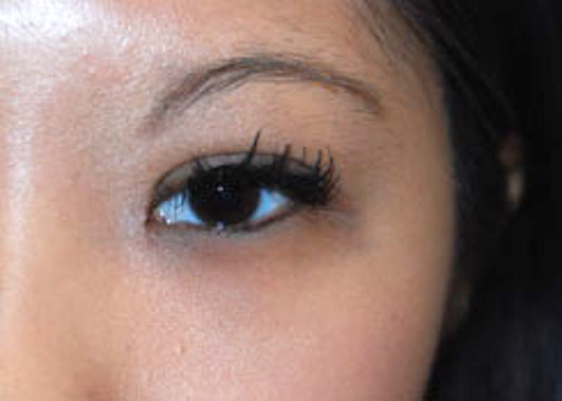 Eye Lift Before & After Gallery - Patient 696920 - Image 2