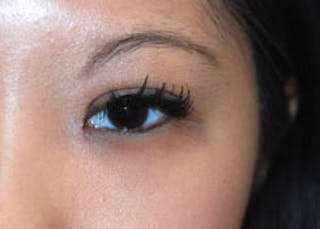 Eye Lift Before & After Gallery - Patient 696920 - Image 2