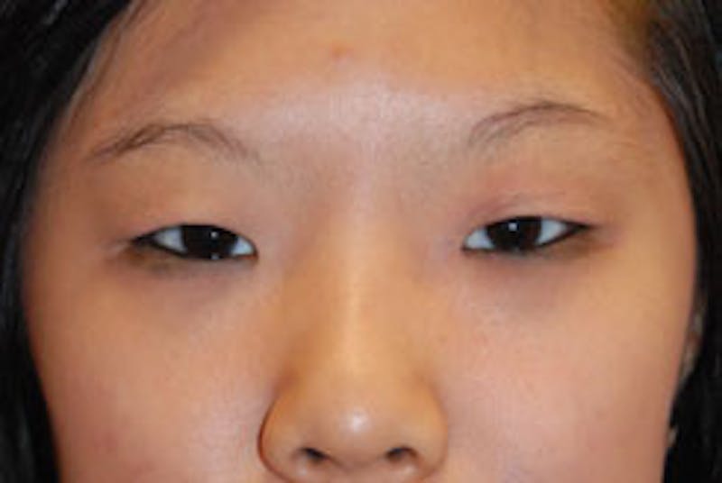 Eye Lift Before & After Gallery - Patient 696920 - Image 3