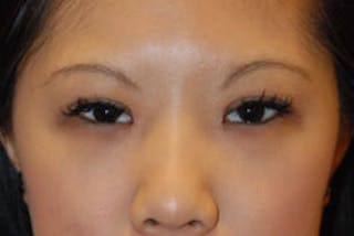 Eye Lift Before & After Gallery - Patient 696920 - Image 4