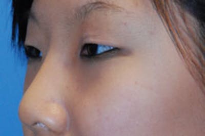 Eye Lift Before & After Gallery - Patient 298260 - Image 1
