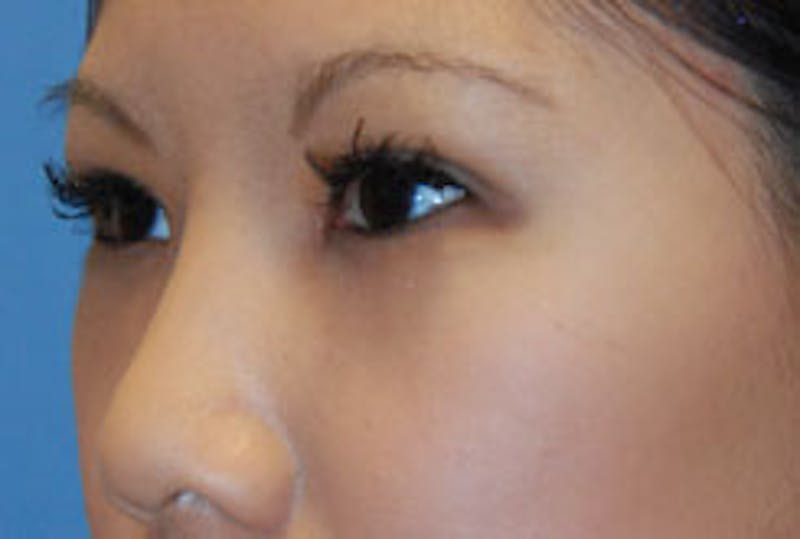 Asian / Ethnic Surgery Before & After Gallery - Patient 150088 - Image 6