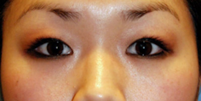 Asian / Ethnic Surgery Before & After Gallery - Patient 683618 - Image 1