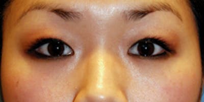 Asian / Ethnic Surgery Before & After Gallery - Patient 683618 - Image 1