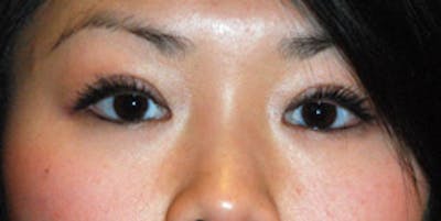 Asian / Ethnic Surgery Before & After Gallery - Patient 683618 - Image 2