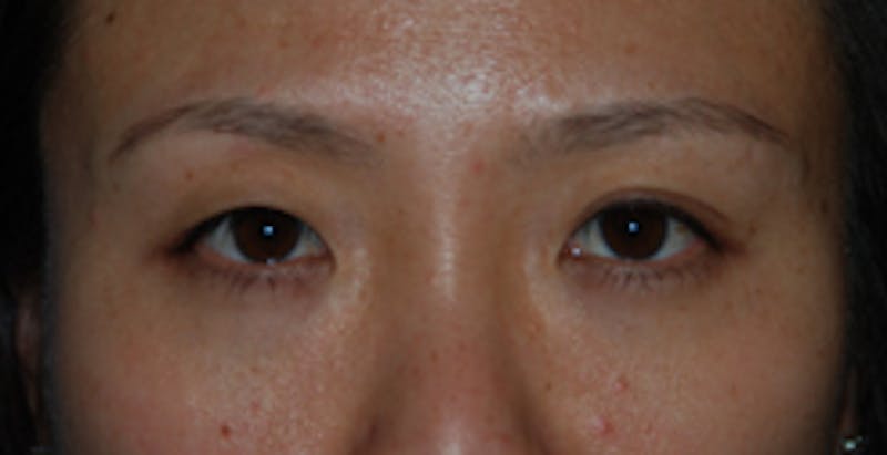 Asian / Ethnic Surgery Before & After Gallery - Patient 333844 - Image 1