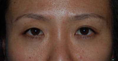 Asian / Ethnic Surgery Before & After Gallery - Patient 333844 - Image 1