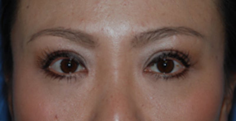 Asian / Ethnic Surgery Before & After Gallery - Patient 333844 - Image 2